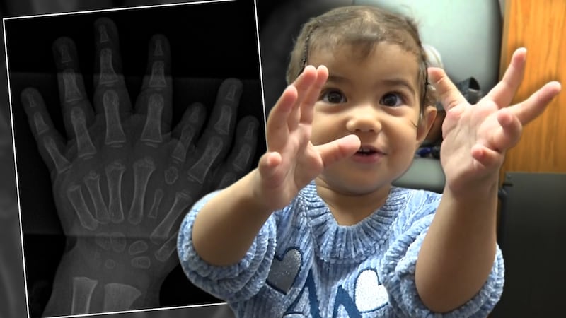 Turkish family travels to America for daughter's hand surgery